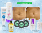 stretch marks kit
